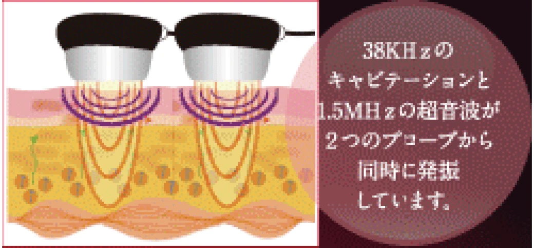 Wデュアルキャビテーション